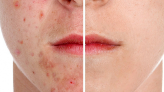 astuces naturelles contre l'acné